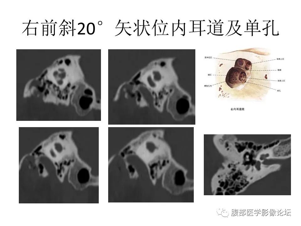 影像PPT - 【PPT】颅骨颅底系列之面面俱到细微处（面神经）-24