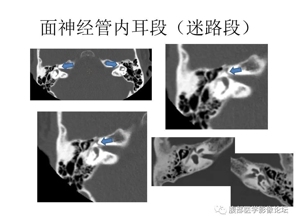 影像PPT - 【PPT】颅骨颅底系列之面面俱到细微处（面神经）-26