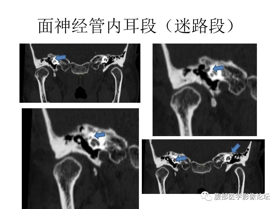 影像PPT - 【PPT】颅骨颅底系列之面面俱到细微处（面神经）-27