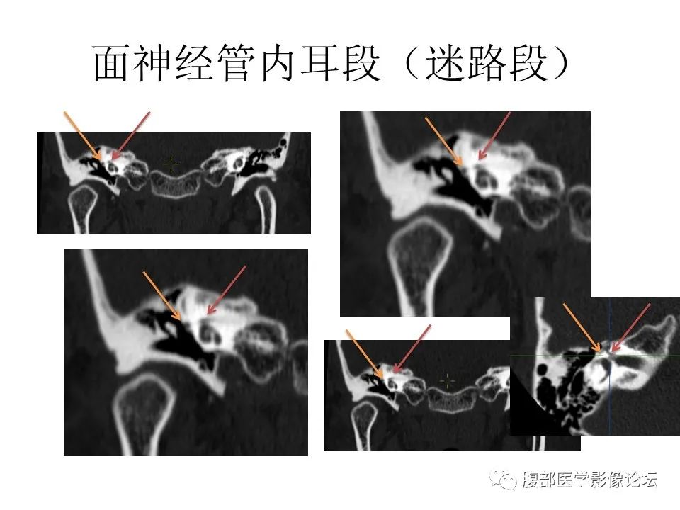 影像PPT - 【PPT】颅骨颅底系列之面面俱到细微处（面神经）-28