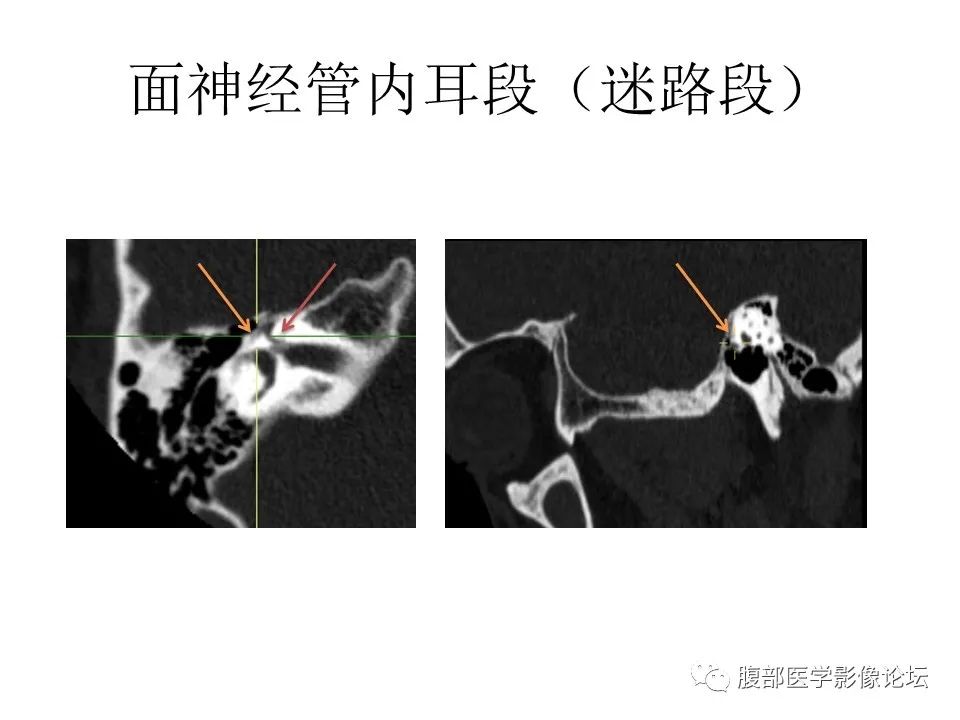 影像PPT - 【PPT】颅骨颅底系列之面面俱到细微处（面神经）-30