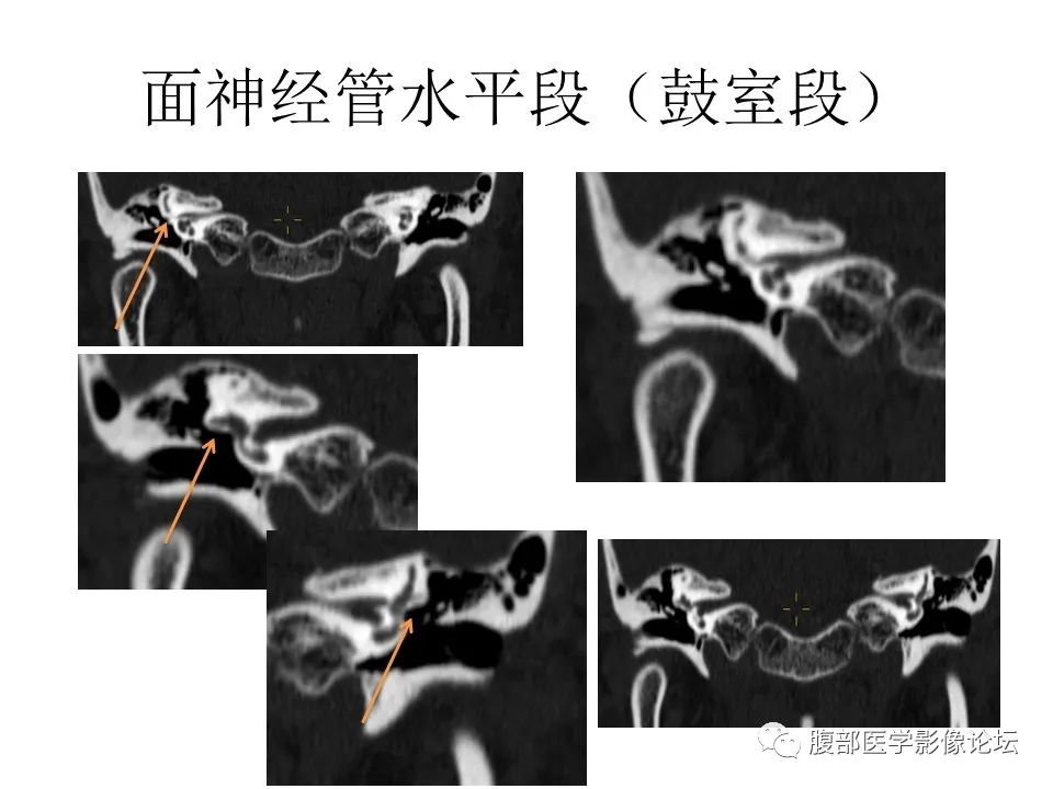 影像PPT - 【PPT】颅骨颅底系列之面面俱到细微处（面神经）-32