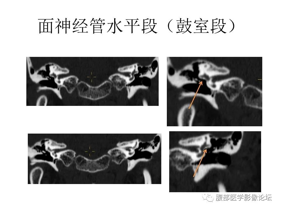 影像PPT - 【PPT】颅骨颅底系列之面面俱到细微处（面神经）-33
