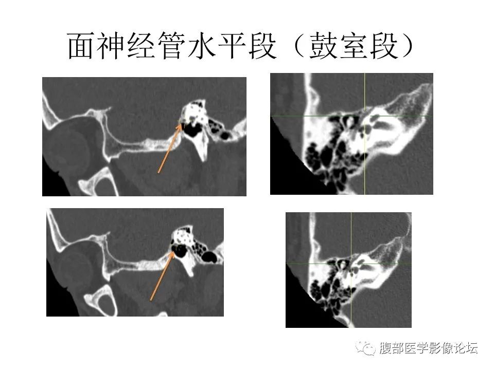 影像PPT - 【PPT】颅骨颅底系列之面面俱到细微处（面神经）-34