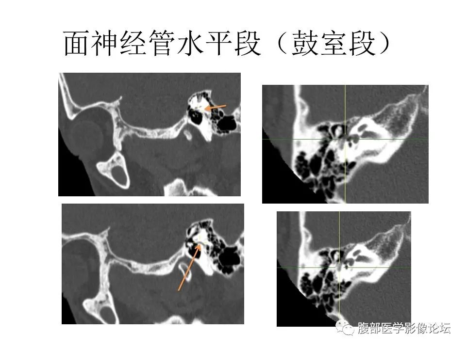 影像PPT - 【PPT】颅骨颅底系列之面面俱到细微处（面神经）-35