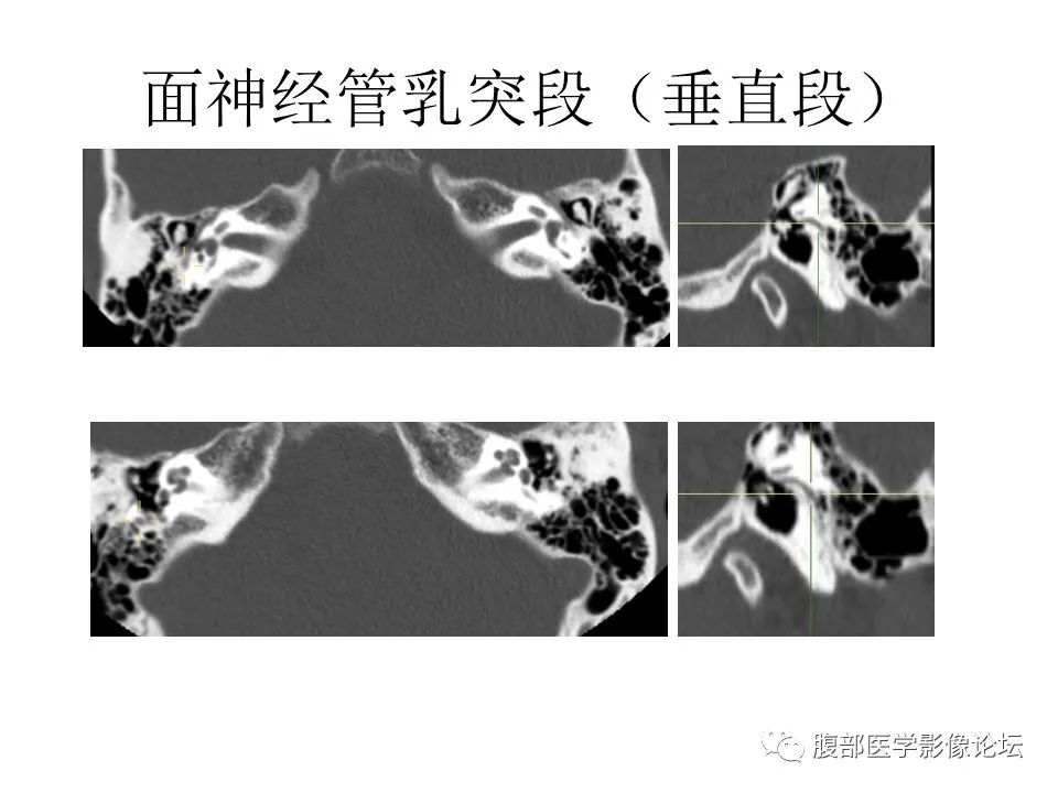 影像PPT - 【PPT】颅骨颅底系列之面面俱到细微处（面神经）-36