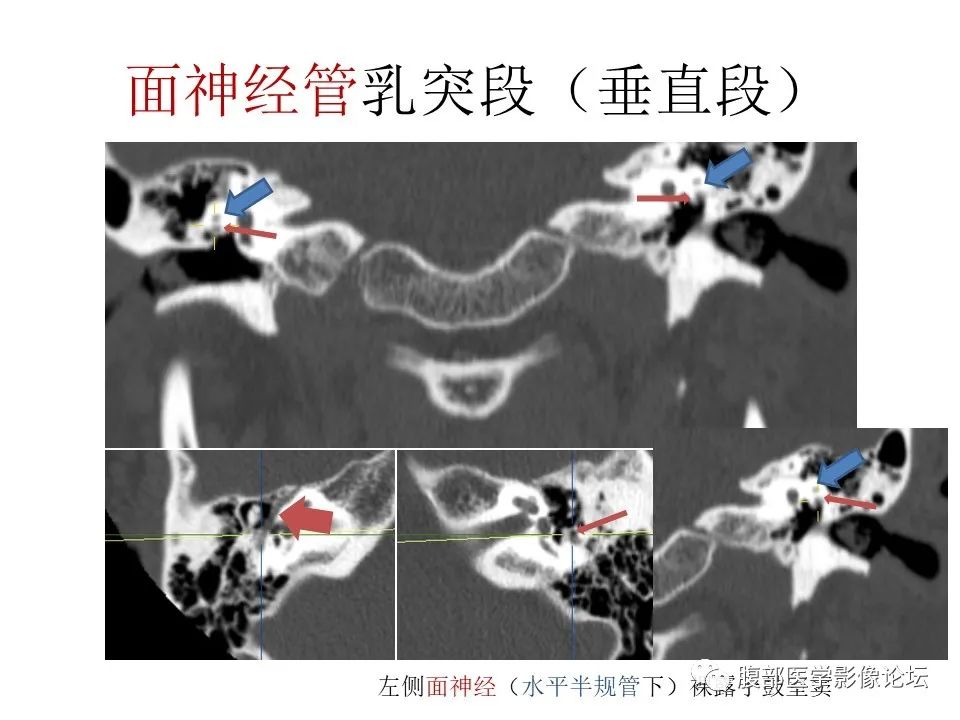 影像PPT - 【PPT】颅骨颅底系列之面面俱到细微处（面神经）-37
