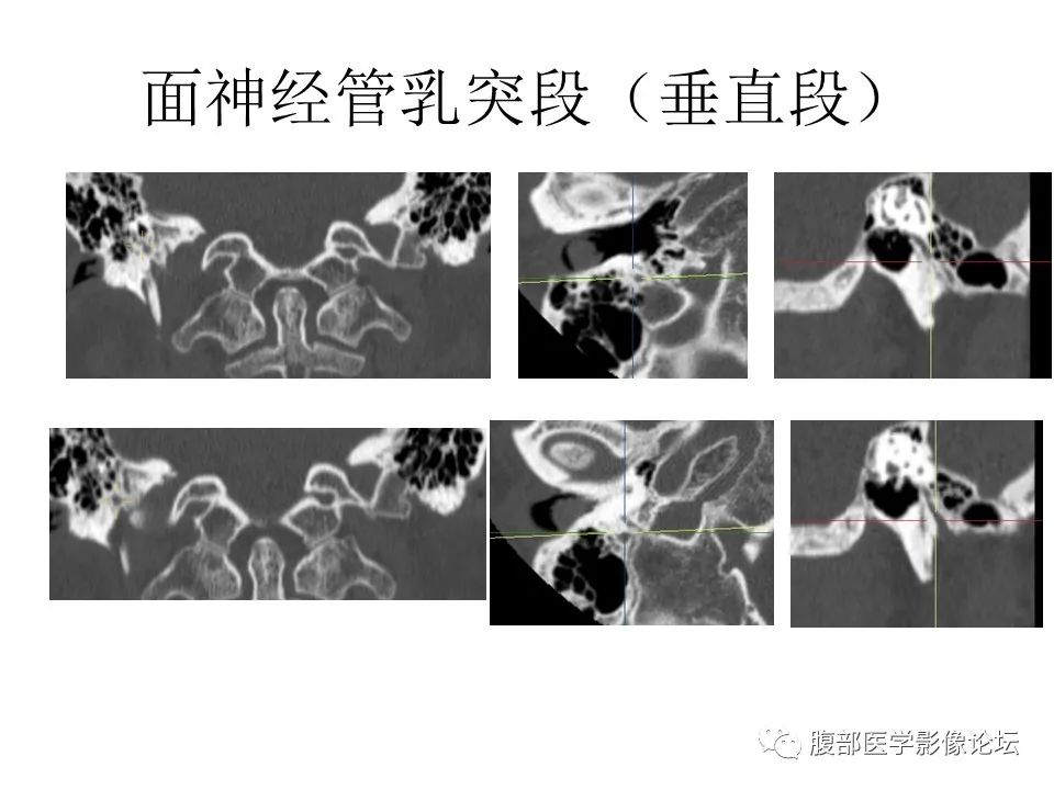 影像PPT - 【PPT】颅骨颅底系列之面面俱到细微处（面神经）-38