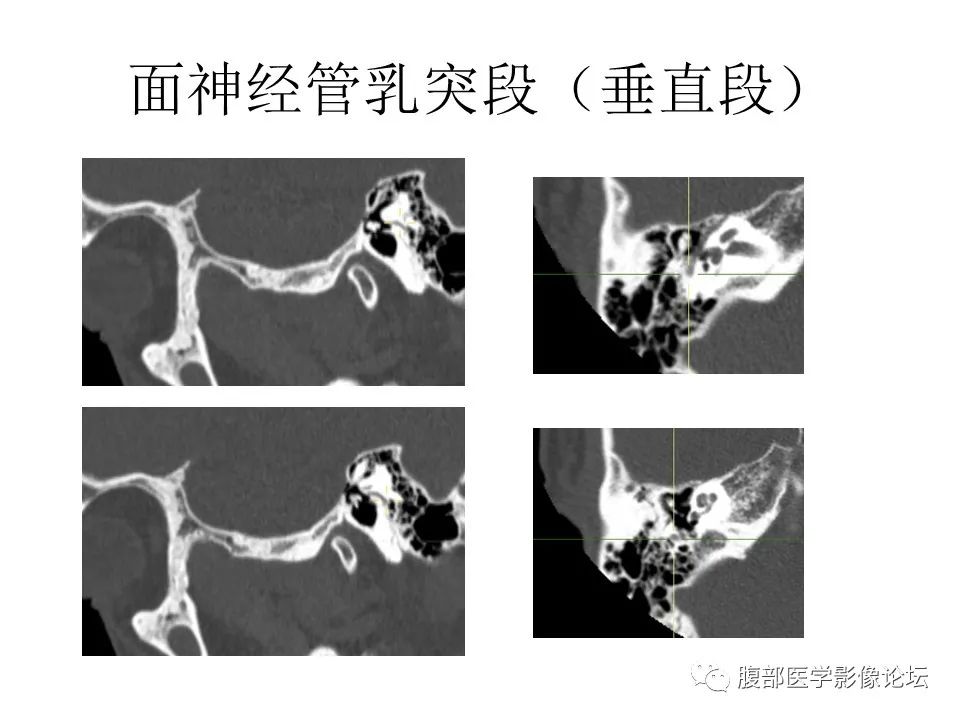 影像PPT - 【PPT】颅骨颅底系列之面面俱到细微处（面神经）-39