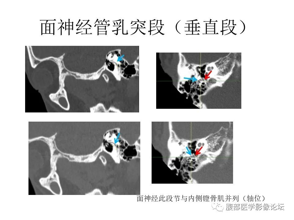 影像PPT - 【PPT】颅骨颅底系列之面面俱到细微处（面神经）-40