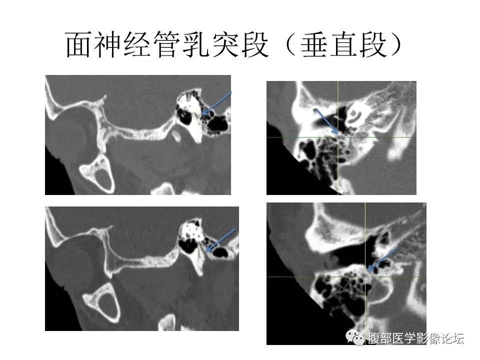 影像PPT - 【PPT】颅骨颅底系列之面面俱到细微处（面神经）-41