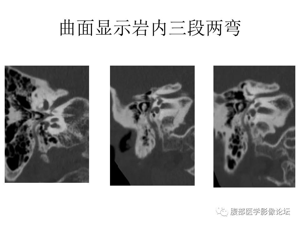 影像PPT - 【PPT】颅骨颅底系列之面面俱到细微处（面神经）-43