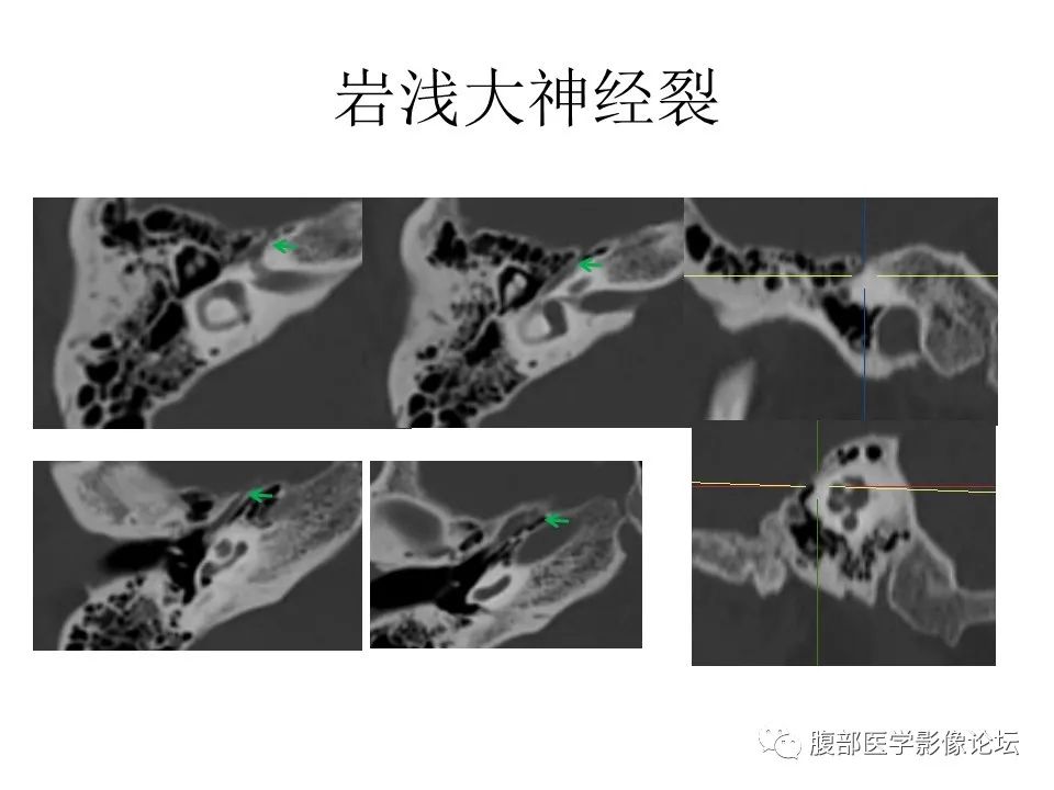 影像PPT - 【PPT】颅骨颅底系列之面面俱到细微处（面神经）-48