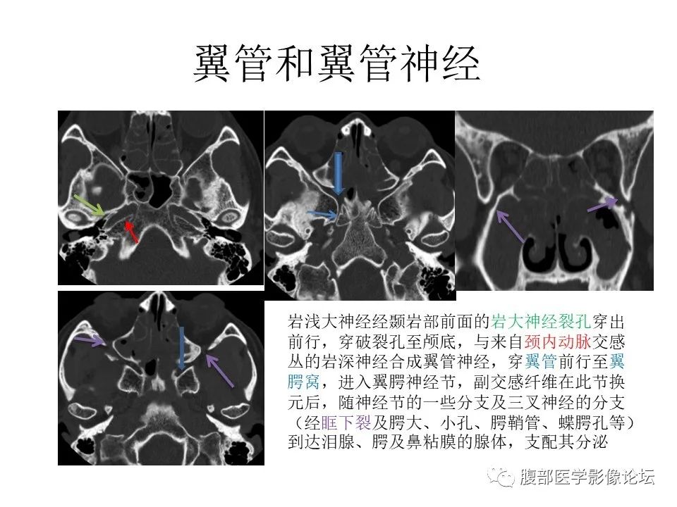影像PPT - 【PPT】颅骨颅底系列之面面俱到细微处（面神经）-50