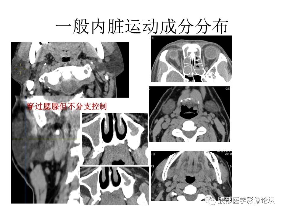 影像PPT - 【PPT】颅骨颅底系列之面面俱到细微处（面神经）-53