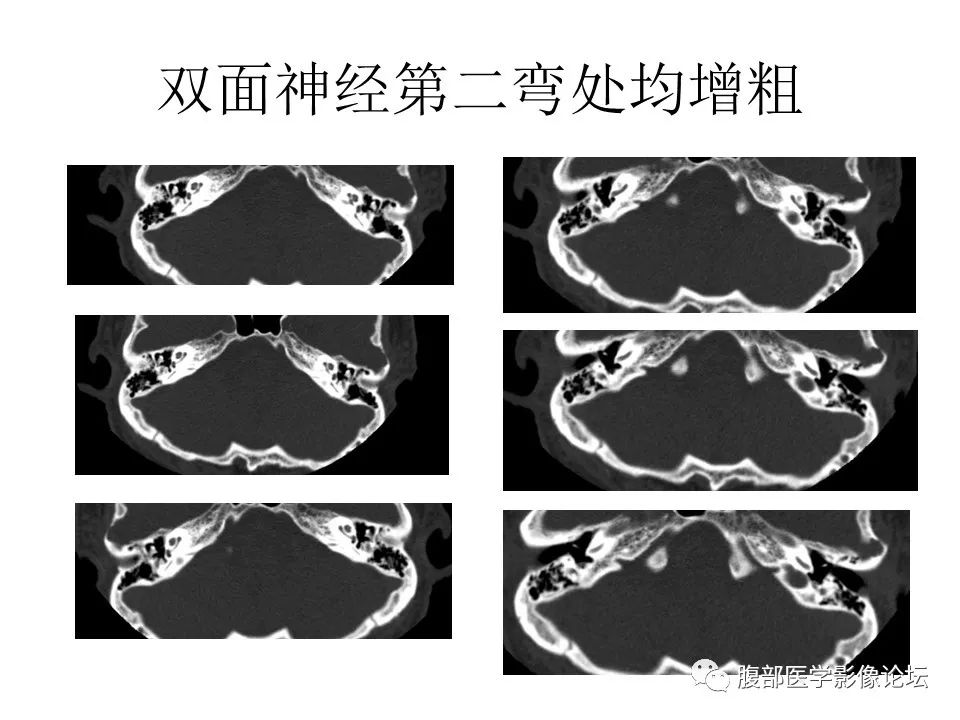 影像PPT - 【PPT】颅骨颅底系列之面面俱到细微处（面神经）-55