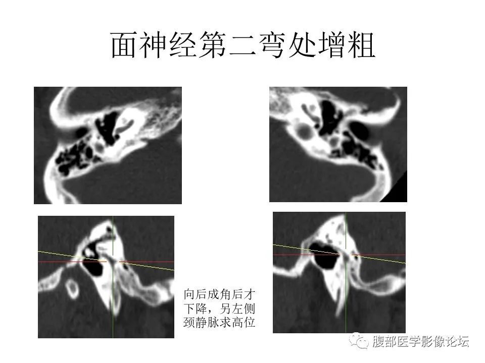影像PPT - 【PPT】颅骨颅底系列之面面俱到细微处（面神经）-56