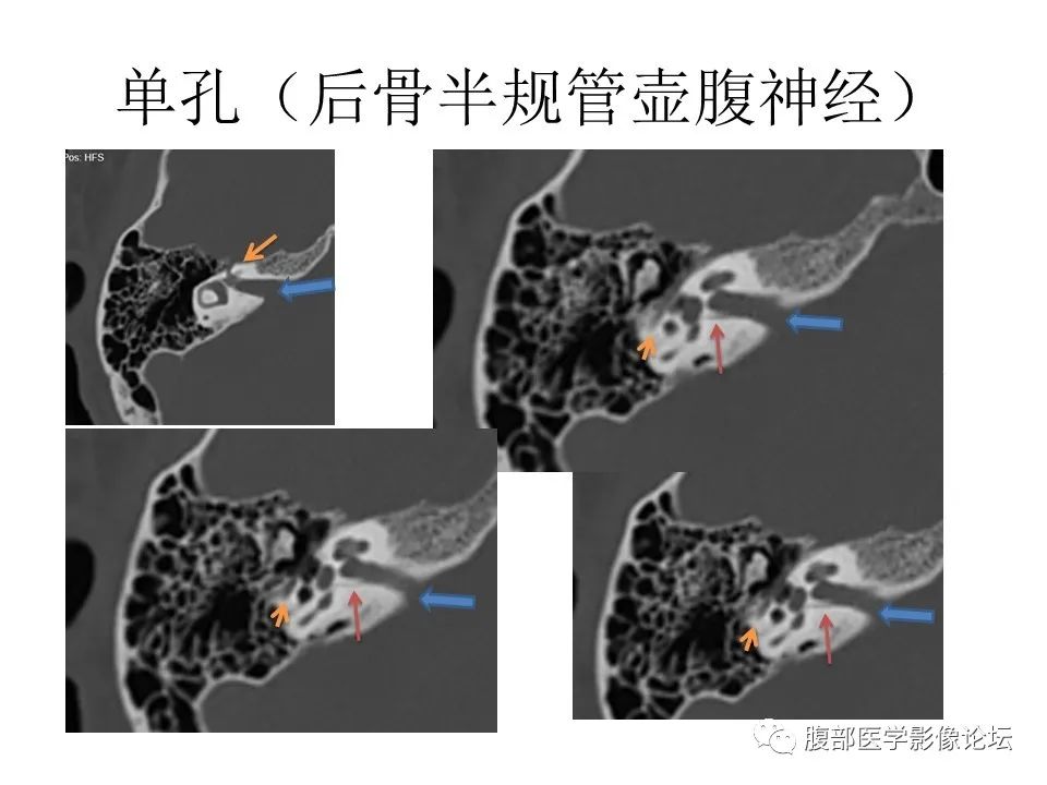 影像PPT - 【PPT】颅骨颅底系列之面面俱到细微处（面神经）-58