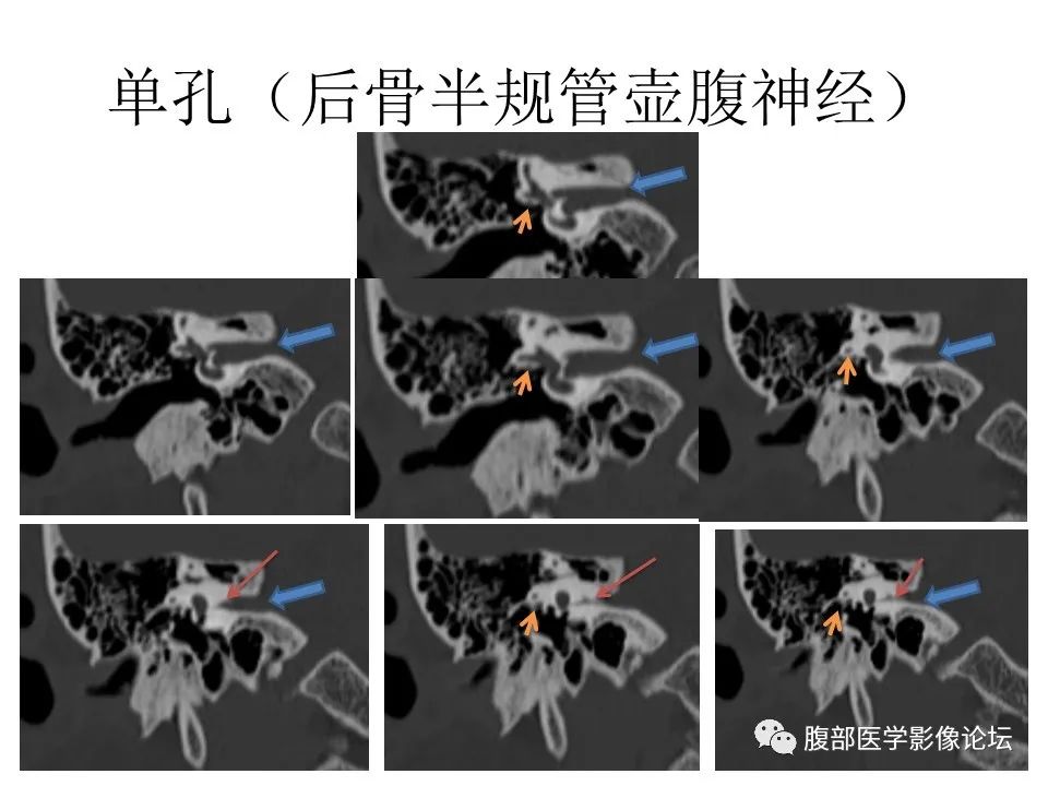 影像PPT - 【PPT】颅骨颅底系列之面面俱到细微处（面神经）-59