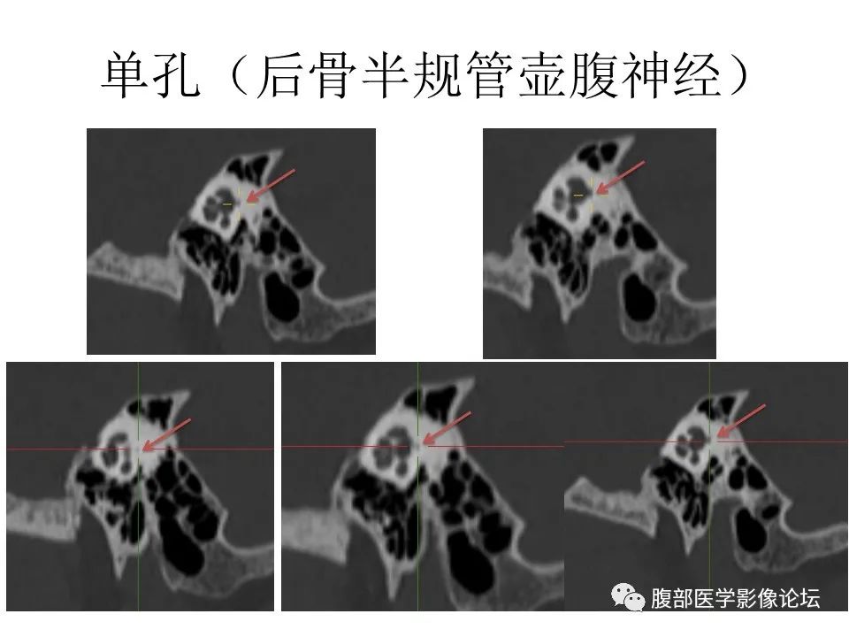 影像PPT - 【PPT】颅骨颅底系列之面面俱到细微处（面神经）-60