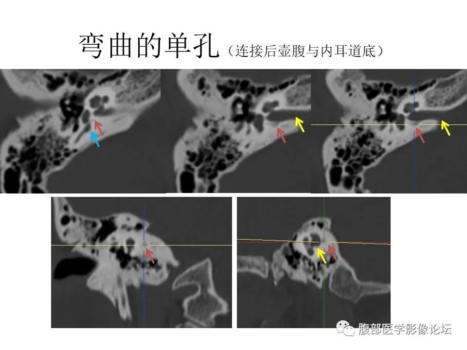 影像PPT - 【PPT】颅骨颅底系列之面面俱到细微处（面神经）-61