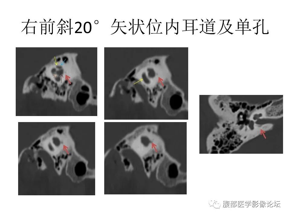 影像PPT - 【PPT】颅骨颅底系列之面面俱到细微处（面神经）-62
