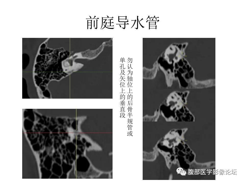 影像PPT - 【PPT】颅骨颅底系列之面面俱到细微处（面神经）-63