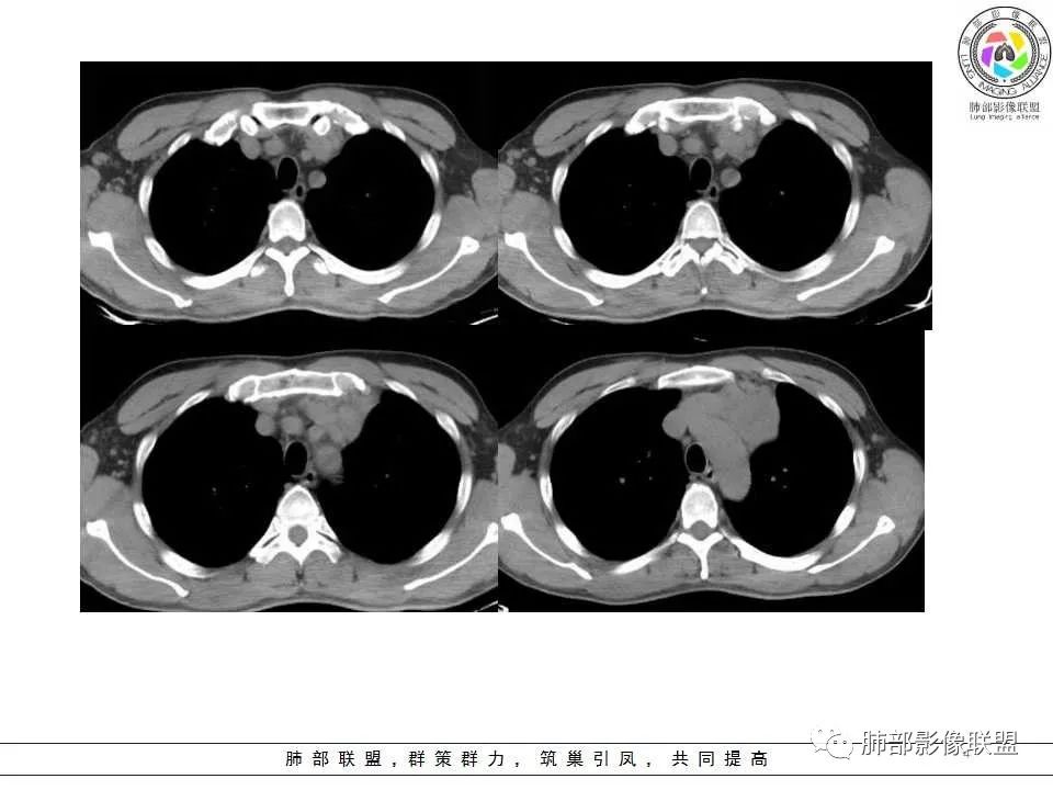 影像PPT - 【病例】纵隔神经内分泌癌1例CT影像讨论-2 影像PPT - 【病例】纵隔神经内分泌癌1例CT影像讨论-2