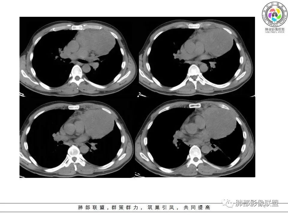 影像PPT - 【病例】纵隔神经内分泌癌1例CT影像讨论-4 影像PPT - 【病例】纵隔神经内分泌癌1例CT影像讨论-4
