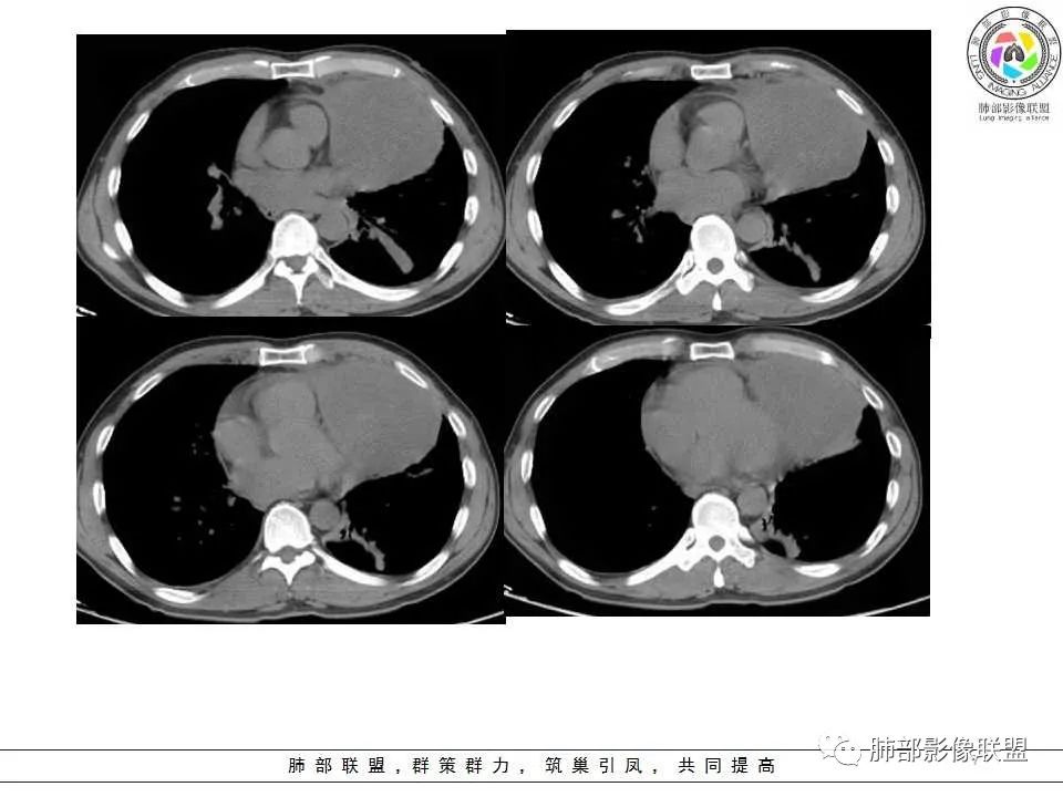 影像PPT - 【病例】纵隔神经内分泌癌1例CT影像讨论-5 影像PPT - 【病例】纵隔神经内分泌癌1例CT影像讨论-5