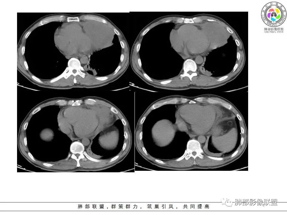 影像PPT - 【病例】纵隔神经内分泌癌1例CT影像讨论-6 影像PPT - 【病例】纵隔神经内分泌癌1例CT影像讨论-6