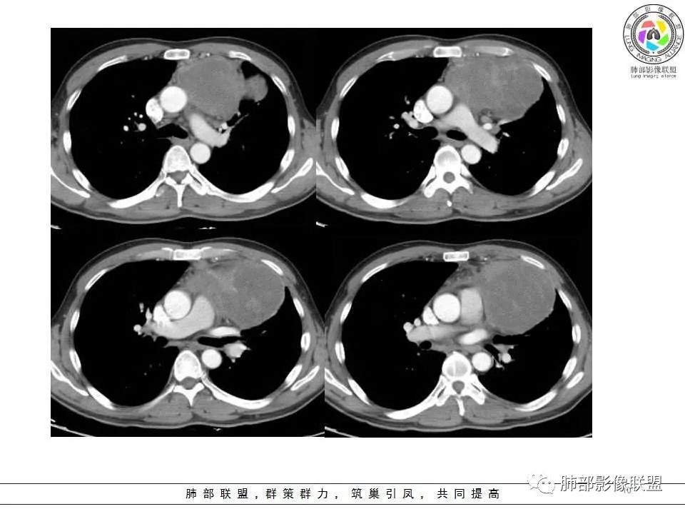 影像PPT - 【病例】纵隔神经内分泌癌1例CT影像讨论-8 影像PPT - 【病例】纵隔神经内分泌癌1例CT影像讨论-8
