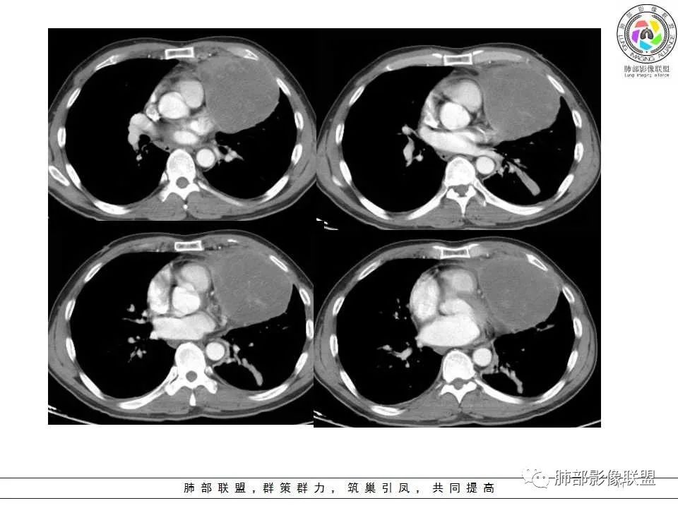 影像PPT - 【病例】纵隔神经内分泌癌1例CT影像讨论-9 影像PPT - 【病例】纵隔神经内分泌癌1例CT影像讨论-9