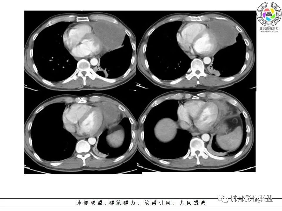 影像PPT - 【病例】纵隔神经内分泌癌1例CT影像讨论-10 影像PPT - 【病例】纵隔神经内分泌癌1例CT影像讨论-10