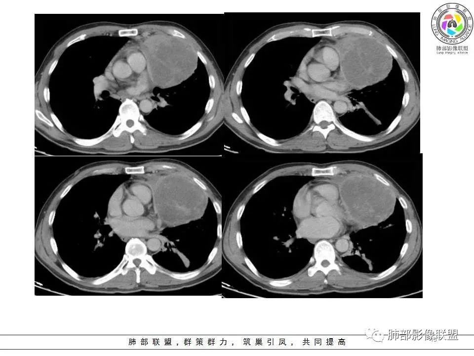 影像PPT - 【病例】纵隔神经内分泌癌1例CT影像讨论-13 影像PPT - 【病例】纵隔神经内分泌癌1例CT影像讨论-13