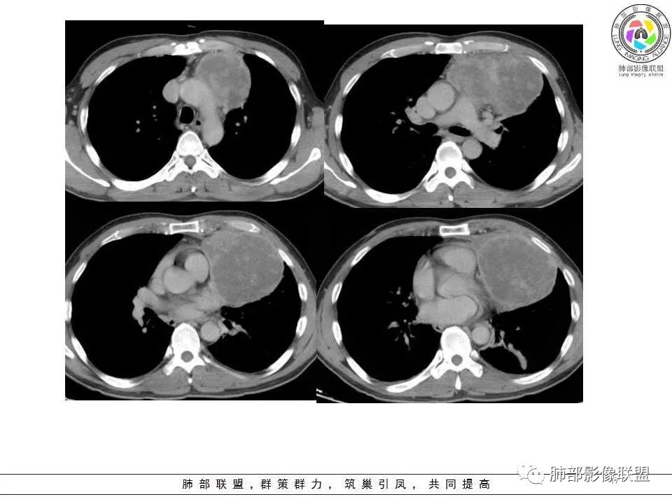 影像PPT - 【病例】纵隔神经内分泌癌1例CT影像讨论-15 影像PPT - 【病例】纵隔神经内分泌癌1例CT影像讨论-15