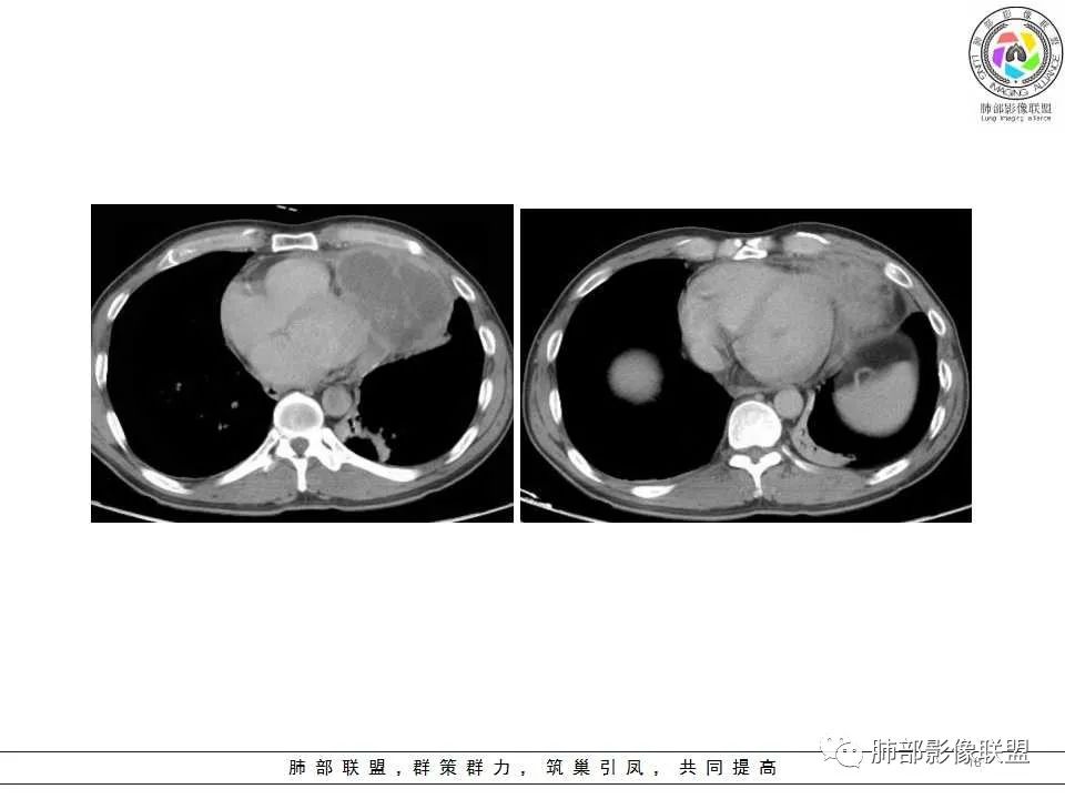 影像PPT - 【病例】纵隔神经内分泌癌1例CT影像讨论-16 影像PPT - 【病例】纵隔神经内分泌癌1例CT影像讨论-16