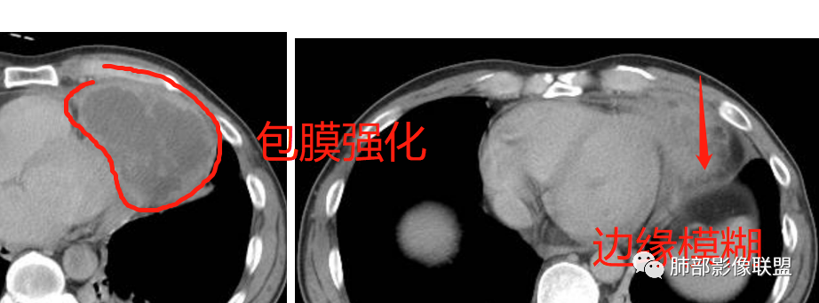 影像PPT - 【病例】纵隔神经内分泌癌1例CT影像讨论-25 影像PPT - 【病例】纵隔神经内分泌癌1例CT影像讨论-25