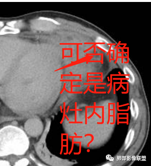 影像PPT - 【病例】纵隔神经内分泌癌1例CT影像讨论-26 影像PPT - 【病例】纵隔神经内分泌癌1例CT影像讨论-26