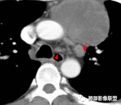 影像PPT - 【病例】纵隔神经内分泌癌1例CT影像讨论-31 影像PPT - 【病例】纵隔神经内分泌癌1例CT影像讨论-31