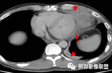 影像PPT - 【病例】纵隔神经内分泌癌1例CT影像讨论-32 影像PPT - 【病例】纵隔神经内分泌癌1例CT影像讨论-32