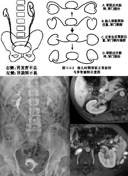 影像PPT - 常见泌尿系统先天发育异常的影像表现-5 影像PPT - 常见泌尿系统先天发育异常的影像表现-5