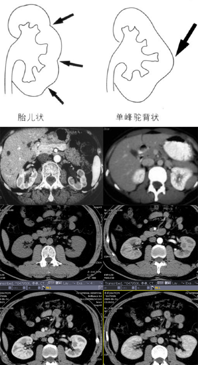 影像PPT - 常见泌尿系统先天发育异常的影像表现-7 影像PPT - 常见泌尿系统先天发育异常的影像表现-7