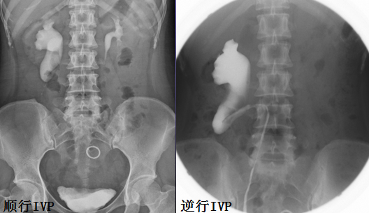 影像PPT - 常见泌尿系统先天发育异常的影像表现-16 影像PPT - 常见泌尿系统先天发育异常的影像表现-16