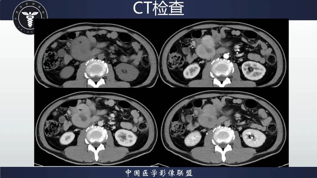 影像PPT - 【病例】胃肠道间质瘤2例CT影像-5