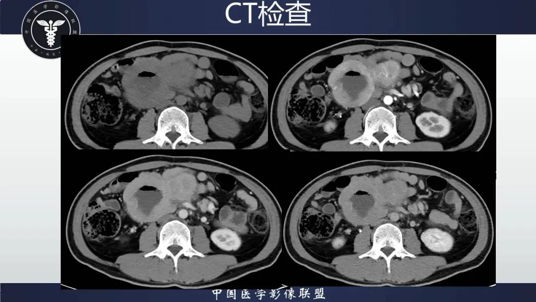 影像PPT - 【病例】胃肠道间质瘤2例CT影像-6