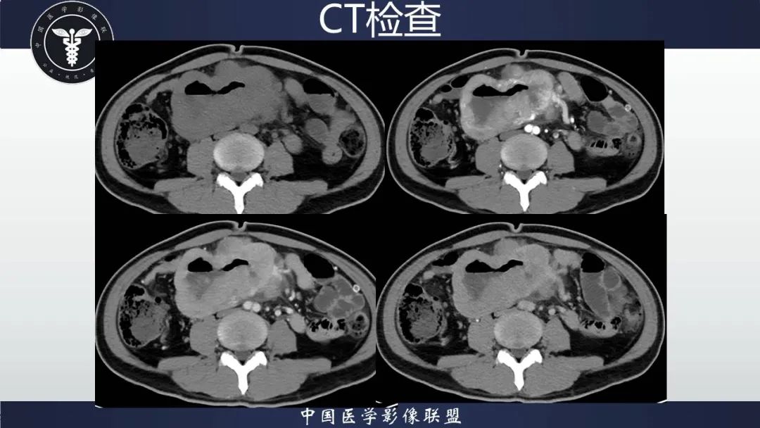 影像PPT - 【病例】胃肠道间质瘤2例CT影像-7