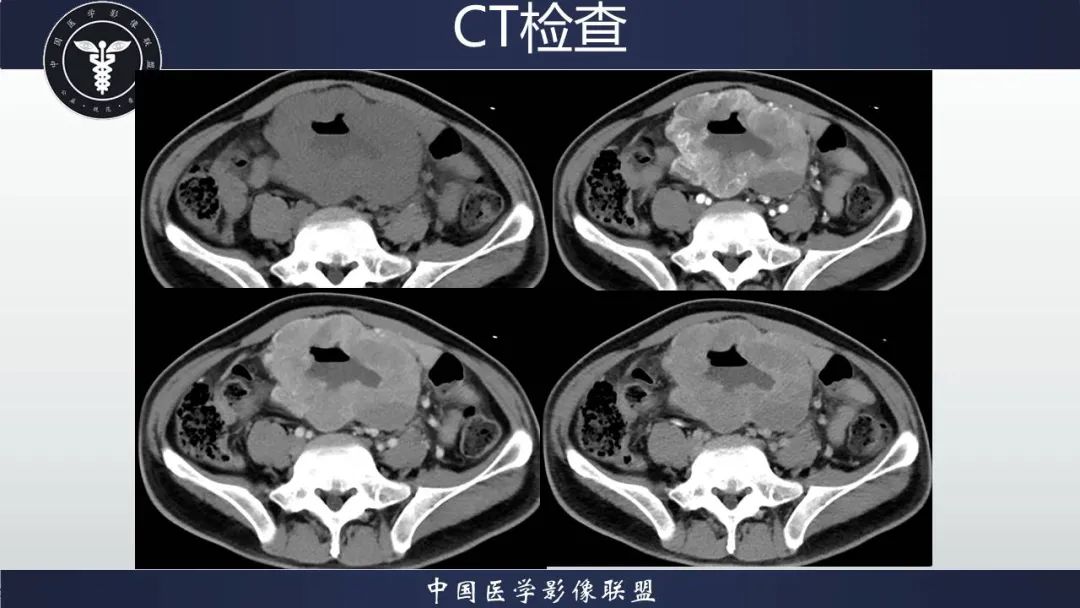 影像PPT - 【病例】胃肠道间质瘤2例CT影像-8