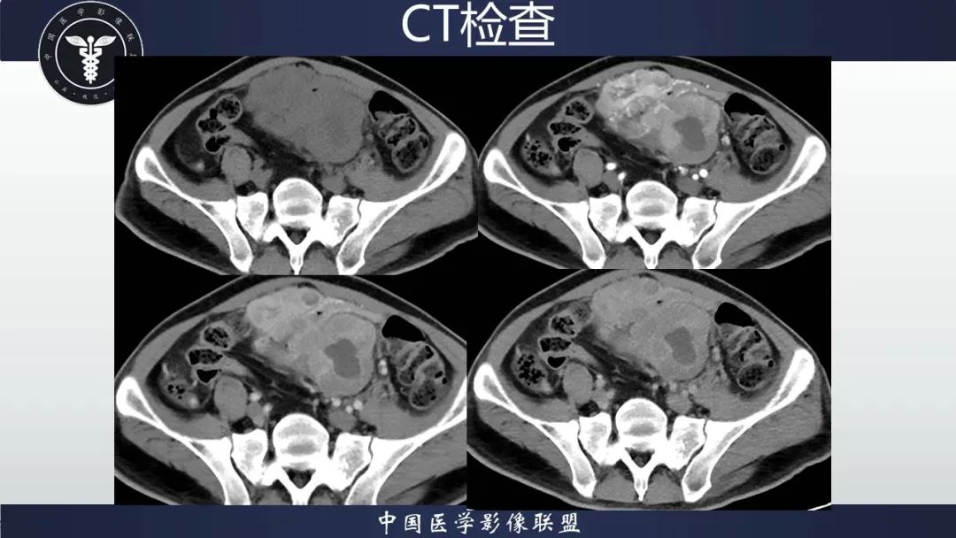 影像PPT - 【病例】胃肠道间质瘤2例CT影像-9