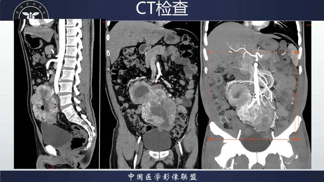影像PPT - 【病例】胃肠道间质瘤2例CT影像-10